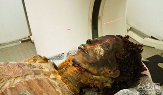 揭开古埃及“木乃伊”的神秘面纱 与动脉硬化症有关