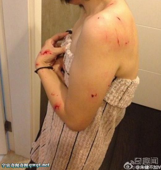 恐怖现场:美女洗澡时玻璃门爆裂 左胸大面积扎伤