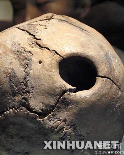 [图文]山东博物馆展出5000年前开颅手术实例颅骨