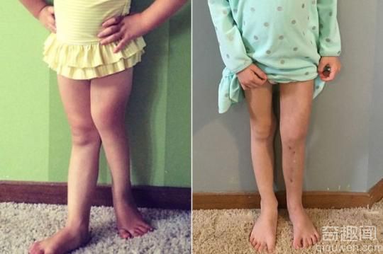 女孩左腿短11厘米 女孩术后恢复需每天打断左腿3次