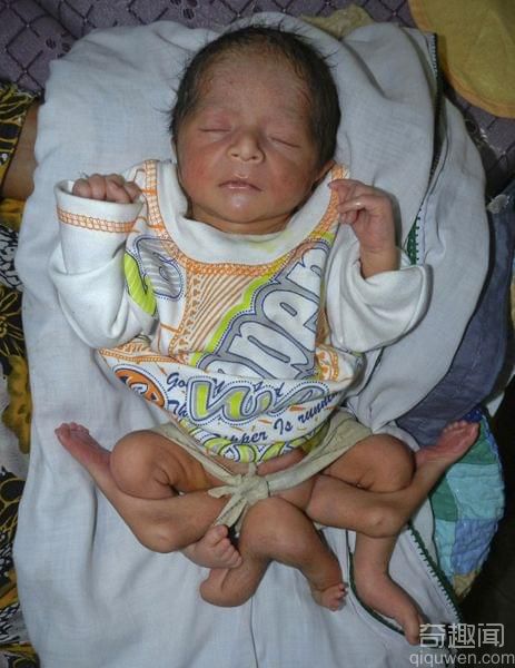 巴基斯坦现6条腿男婴 腹部竟然长出了4肢