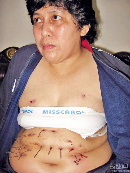 印尼女子腹部和胸部不停地“长出”金属丝