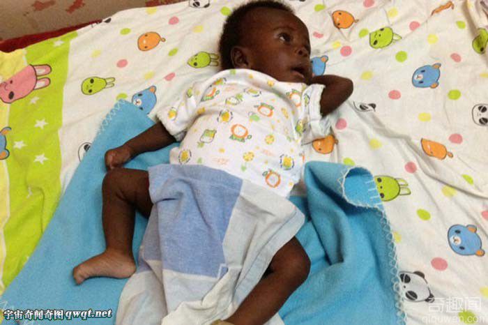 乌干达孕妇产下4手4脚男婴 系罕见寄生双胞胎