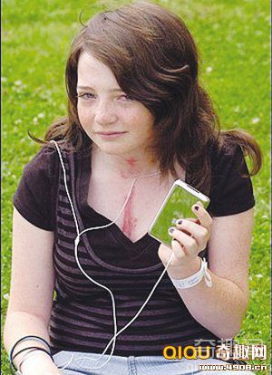 [图文]英国女孩遭雷击因带“随身听”转移部分电流而幸存