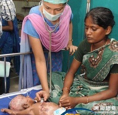 印度男婴出生3个月自燃4次 并未接触火种