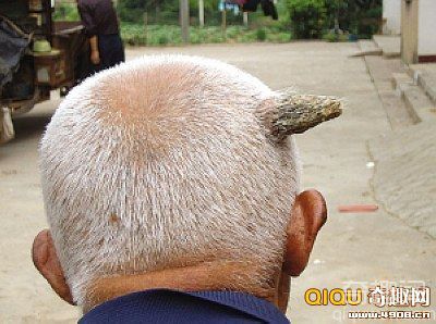 [图文]江苏金坛八旬翁头上长“角” 已长到近6厘米长