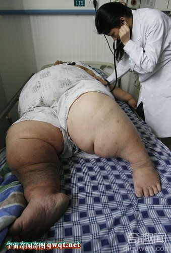 中国第一胖”排尿将体内的腹水排出肚子鼓胀缓解