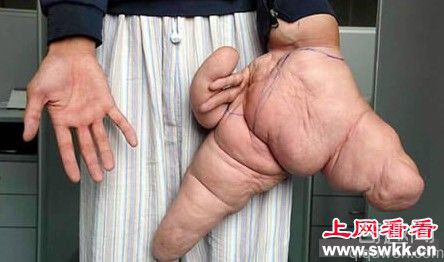 世界上最大的手 24岁的巨指病人刘华