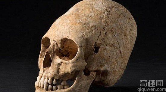 法国发现一个严重畸形的古代妇女头骨 可能是一名贵族.