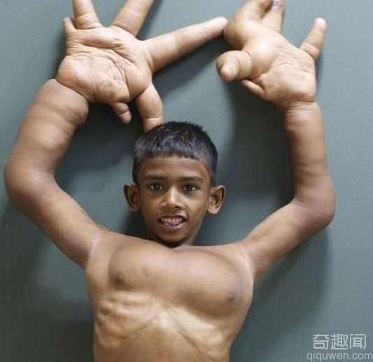 印度男孩长出比两个脑袋还大的巴掌