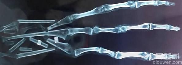秘鲁发现神秘三指手掌 疑似外星人