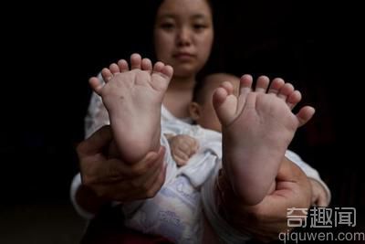 男嬰患罕見多指癥 天生長出了31個手指、腳趾頭