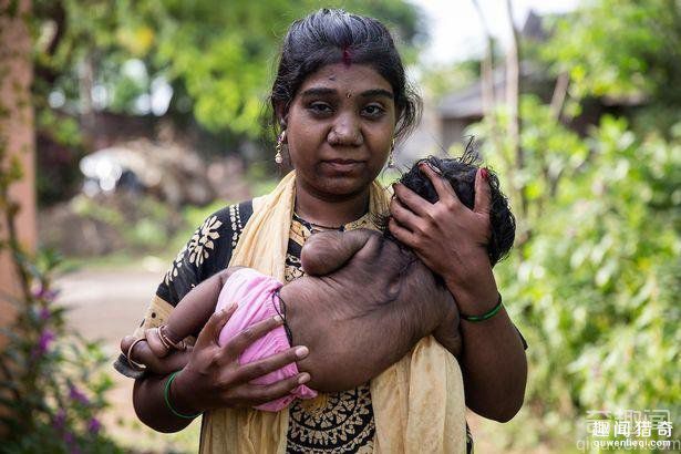 印度女子产下一名男婴 浑身是毛如同狼人