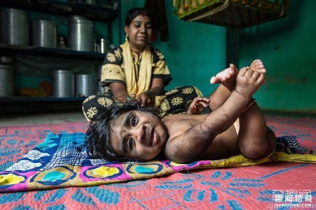 印度女子产下一名男婴 浑身是毛如同狼人