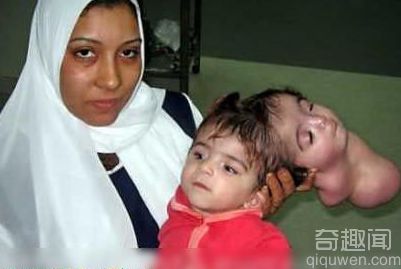 埃及双头小女孩成功进行割头手术