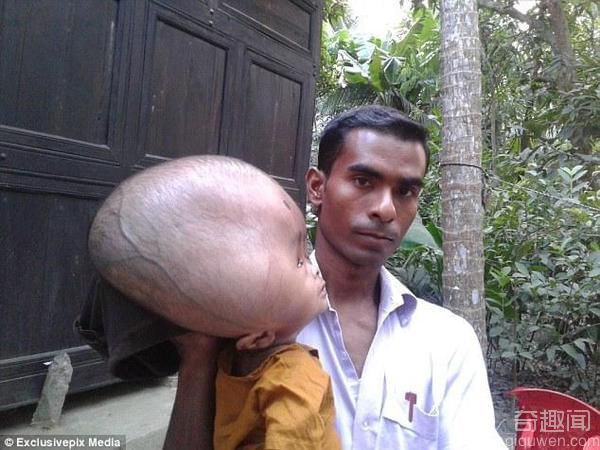孟加拉2岁男孩患脑积水 脑袋是同龄孩子的三倍