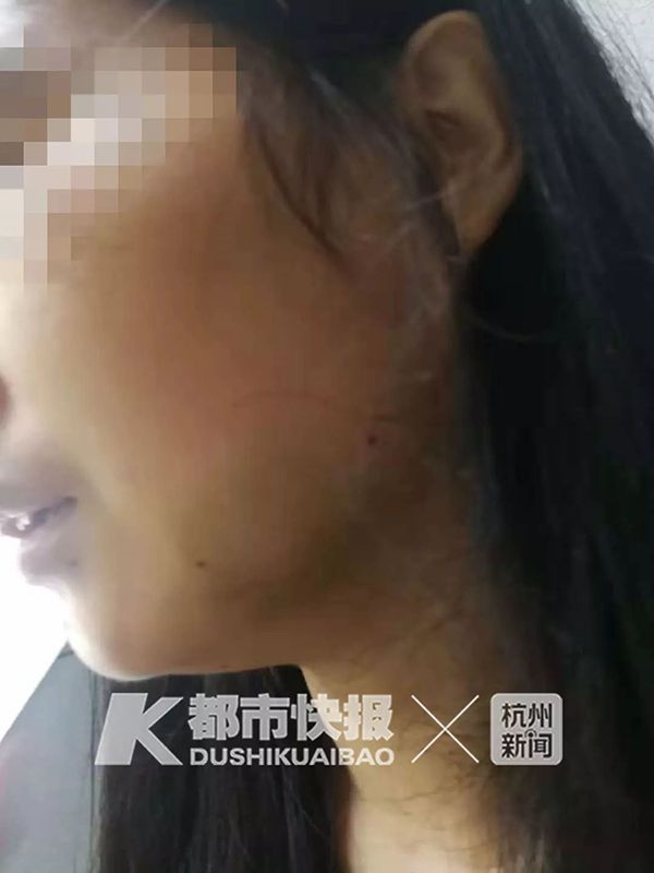 杭州女子为护子被遛狗不牵绳男子打致骨折，警方已传唤打人者