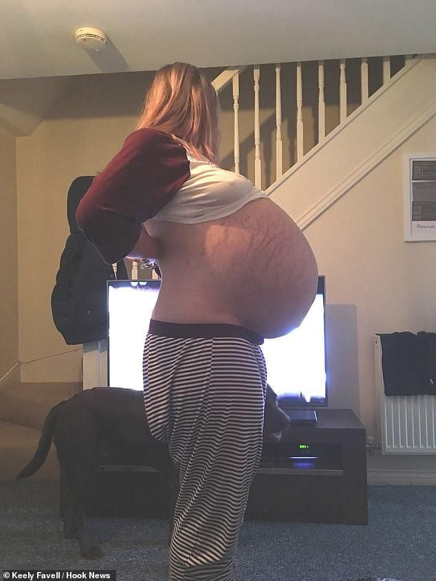 英国女子肚子过大被疑怀孕 实际长了26公斤重囊肿
