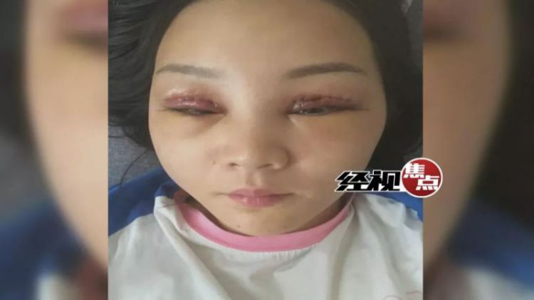 湖南女子花2万元割双眼皮 术后“皮肤坏死”整容变毁容