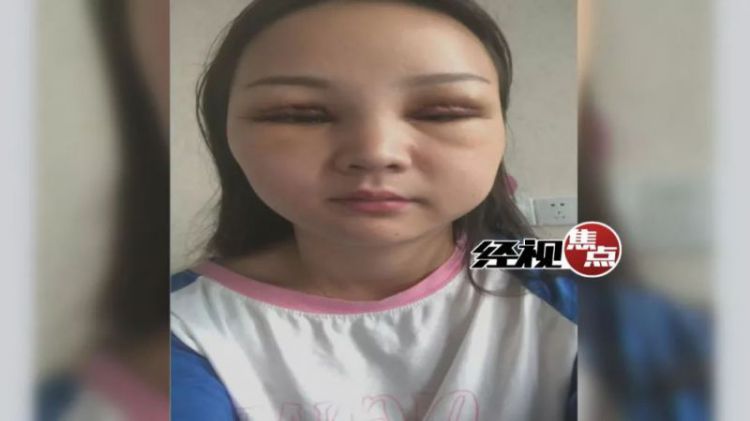 湖南女子花2万元割双眼皮 术后“皮肤坏死”整容变毁容