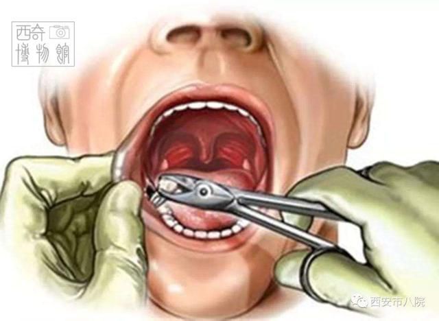 古人发明的奇葩治牙方法，以及古代丧心病狂的拔牙术