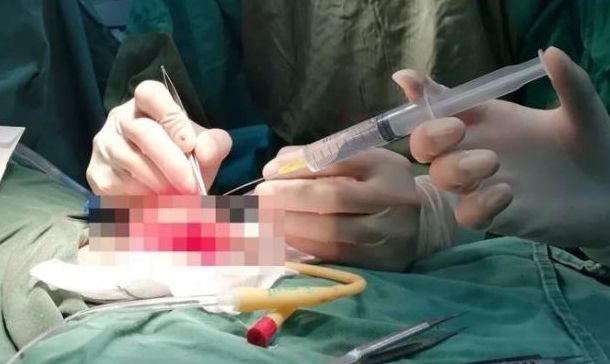 26岁男子挥刀自宫，5小时后才就医，医生通过显微技术4小时接回
