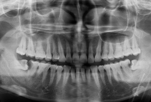 智齿从哪里长出来的：牙弓最靠里的位置(成年后生长)