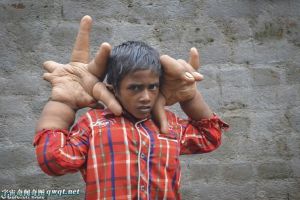 印度8岁男孩长畸形巨手：中指末端长度已达到13英寸