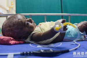  印度男婴出生3个月自燃4次 并未接触火种