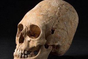  法国发现一个严重畸形的古代妇女头骨 可能是一名贵族.