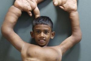 印度男孩长出比两个脑袋还大的巴掌