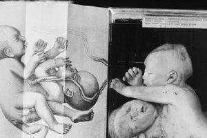 最古老医学博物馆：罕见的双头婴儿标本