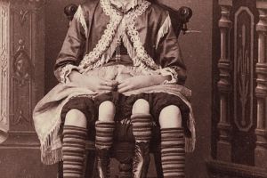 美国两百年前怪异畸形秀  长四条腿女孩狗脸男孩