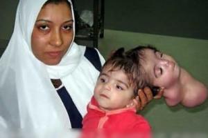 埃及双头小女孩成功进行割头手术