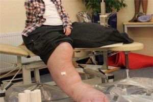 世界上最大最粗的腿是誰 曼迪·塞拉斯（雙腿重兩百多斤）